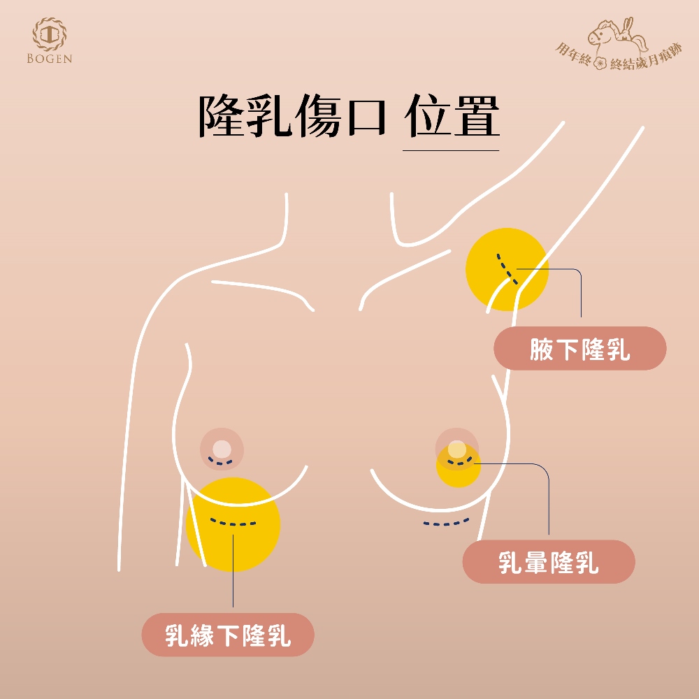 隆乳傷口位置,隆乳傷口,隆乳切口,博恩妍
